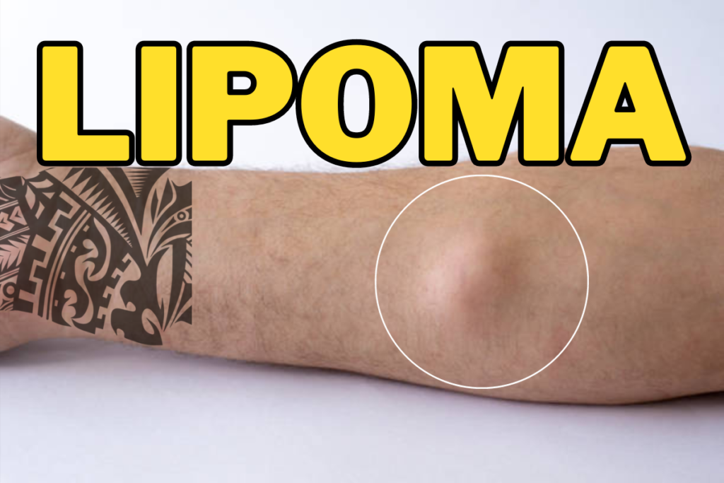 lipoma