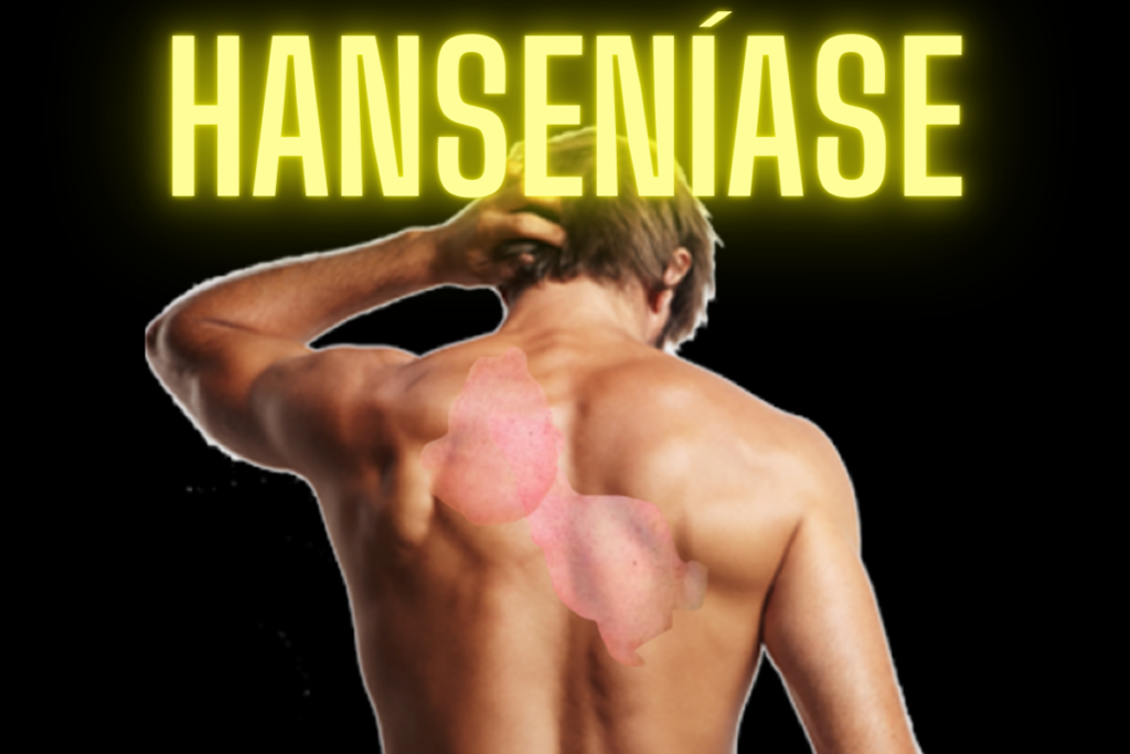 Hanseníase